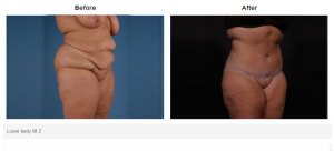 Tummy Tuck result at Bradley Hubbard, MD in Plano, TX