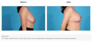 Breast Lift result at Bradley Hubbard, MD in Plano, TX