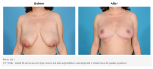 Breast Lift result at Bradley Hubbard, MD in Plano, TX