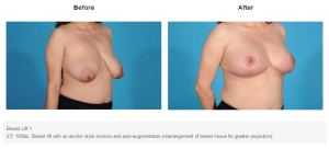 Breast Lift result at Bradley Hubbard, MD in Plano, TX
