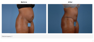 Tummy Tuck result at Bradley Hubbard, MD in Plano, TX
