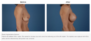 Breast Lift result at Bradley Hubbard, MD in Plano, TX