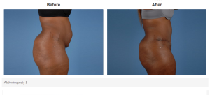 Tummy Tuck result at Bradley Hubbard, MD in Plano, TX