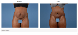 Tummy Tuck result at Bradley Hubbard, MD in Plano, TX