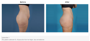 Liposuction result at Bradley Hubbard, MD in Plano, TX