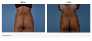 Tummy Tuck result at Bradley Hubbard, MD in Plano, TX
