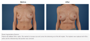 Breast Augmentation result at Bradley Hubbard, MD in Plano, TX