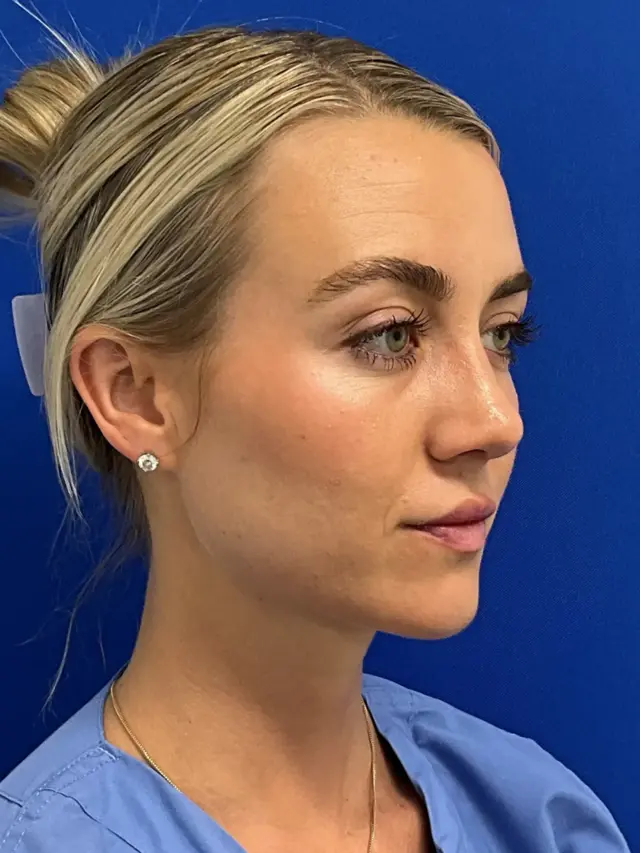 Functional Rhinoplasty after at Palm Beach Plastic Surgery Institute in West Palm Beach, FL
