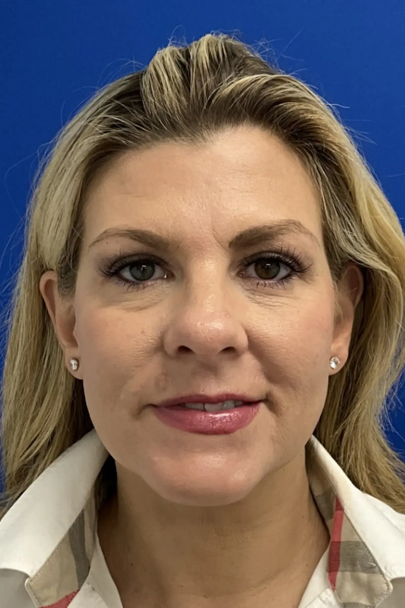 Palm Beach Plastic Surgery Institute blepharoplasty after — West Palm Beach, FL