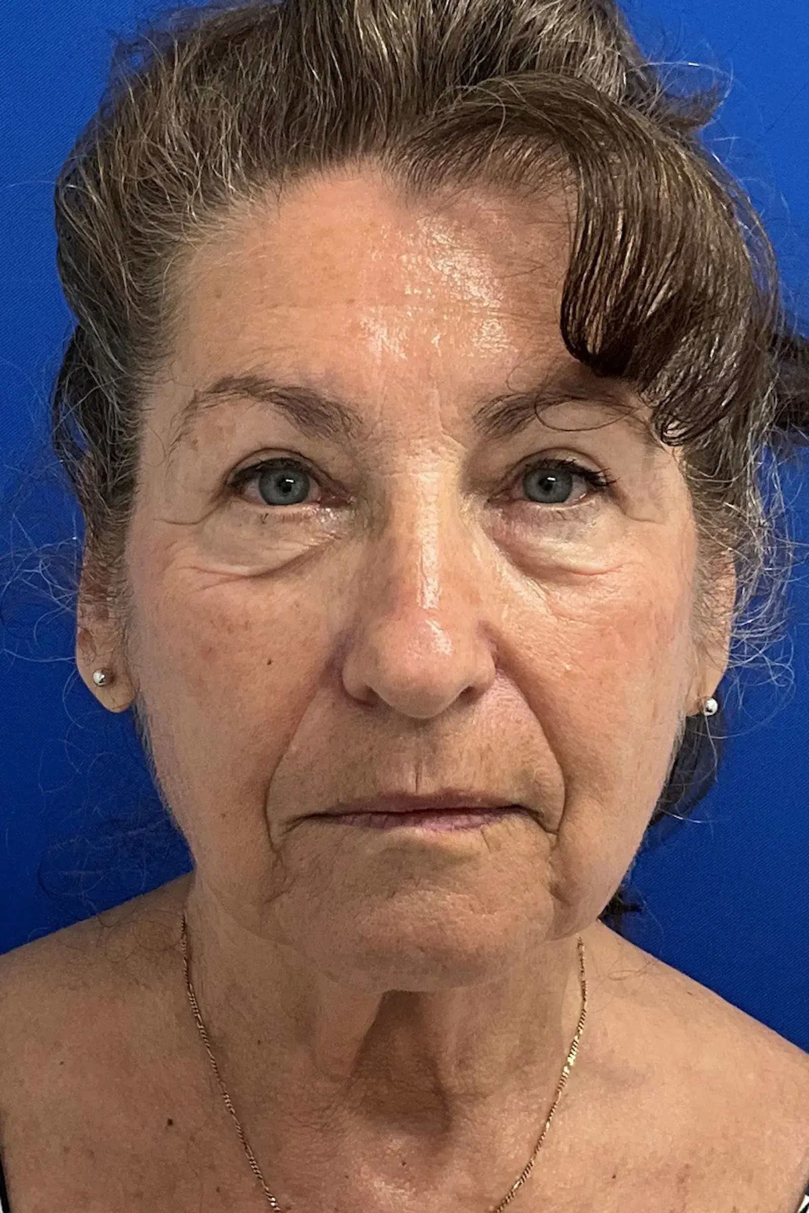 Palm Beach Plastic Surgery Institute blepharoplasty after — West Palm Beach, FL