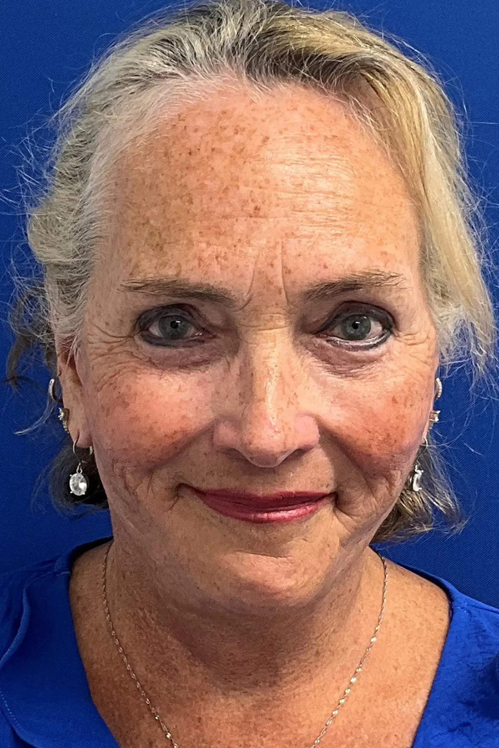 Palm Beach Plastic Surgery Institute facelift after — West Palm Beach, FL