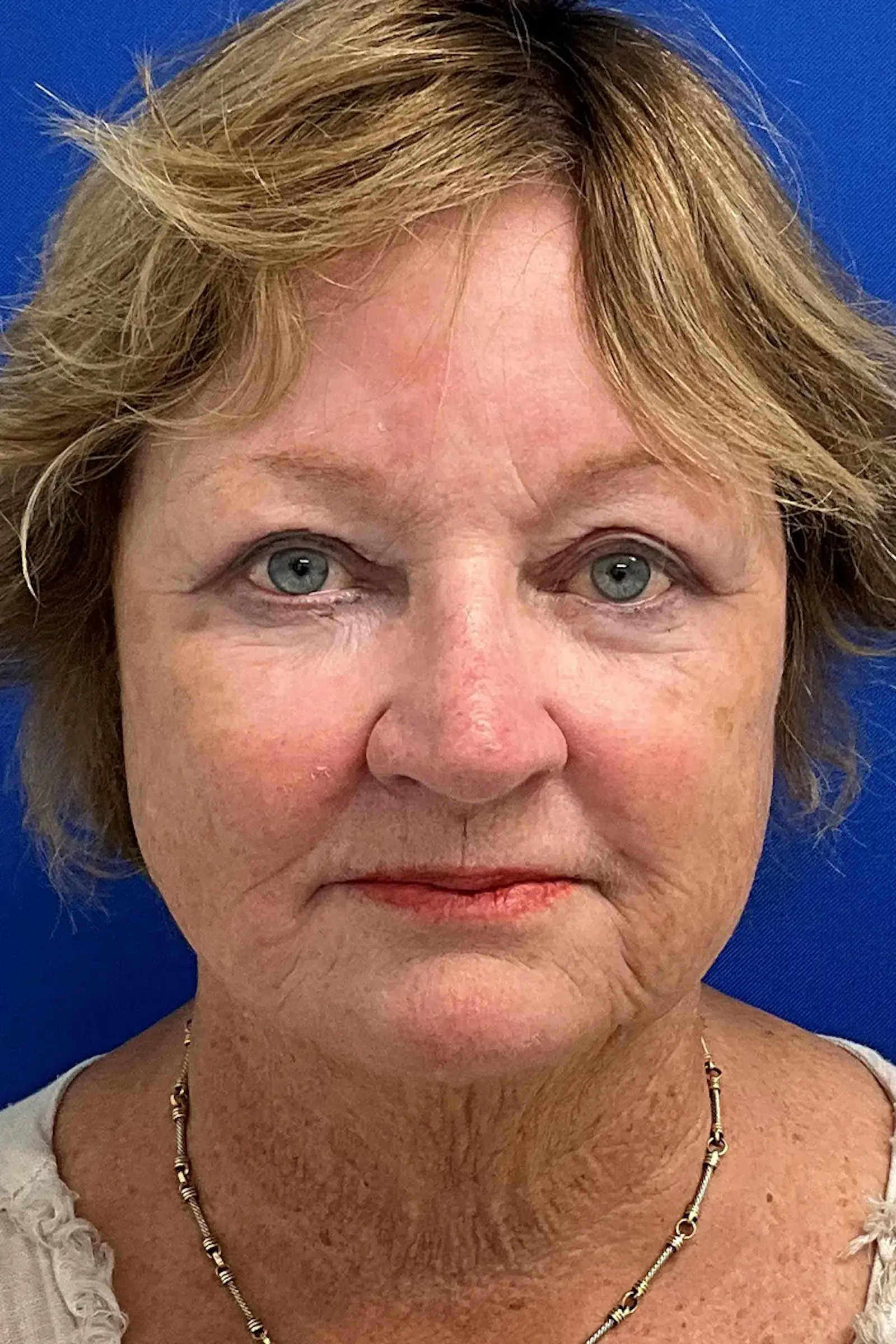 Palm Beach Plastic Surgery Institute blepharoplasty after — West Palm Beach, FL