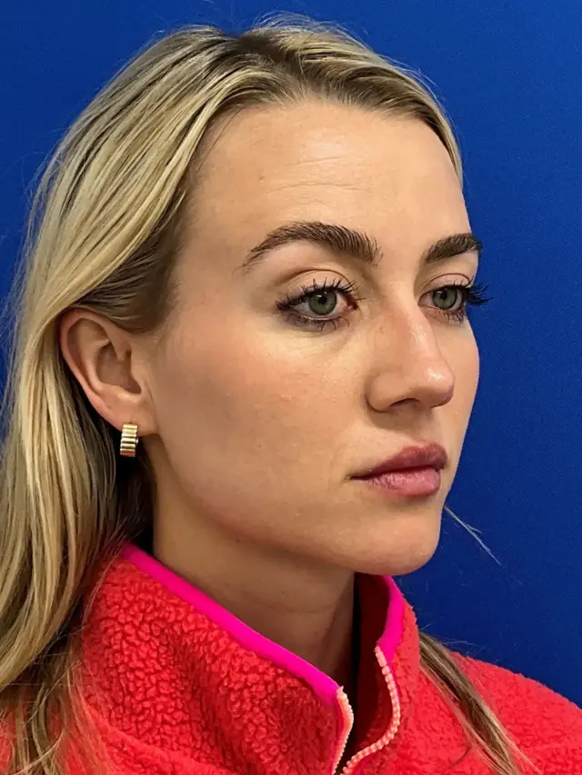 Functional Rhinoplasty before at Palm Beach Plastic Surgery Institute in West Palm Beach, FL