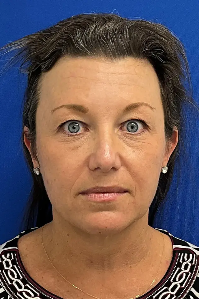 Deep Plane Facelift before at Palm Beach Plastic Surgery Institute in West Palm Beach, FL