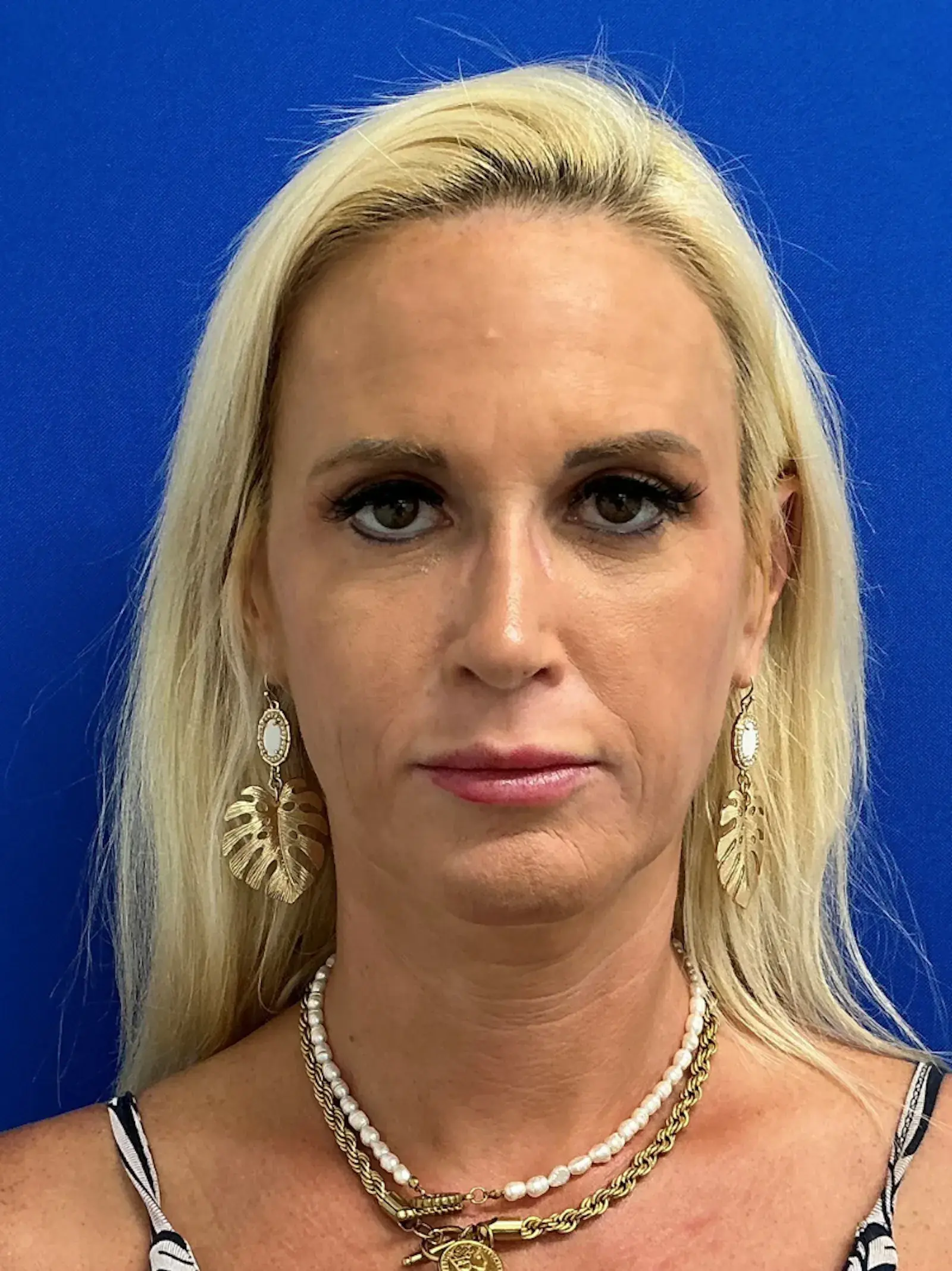 Palm Beach Plastic Surgery Institute rhinoplasty after — West Palm Beach, FL