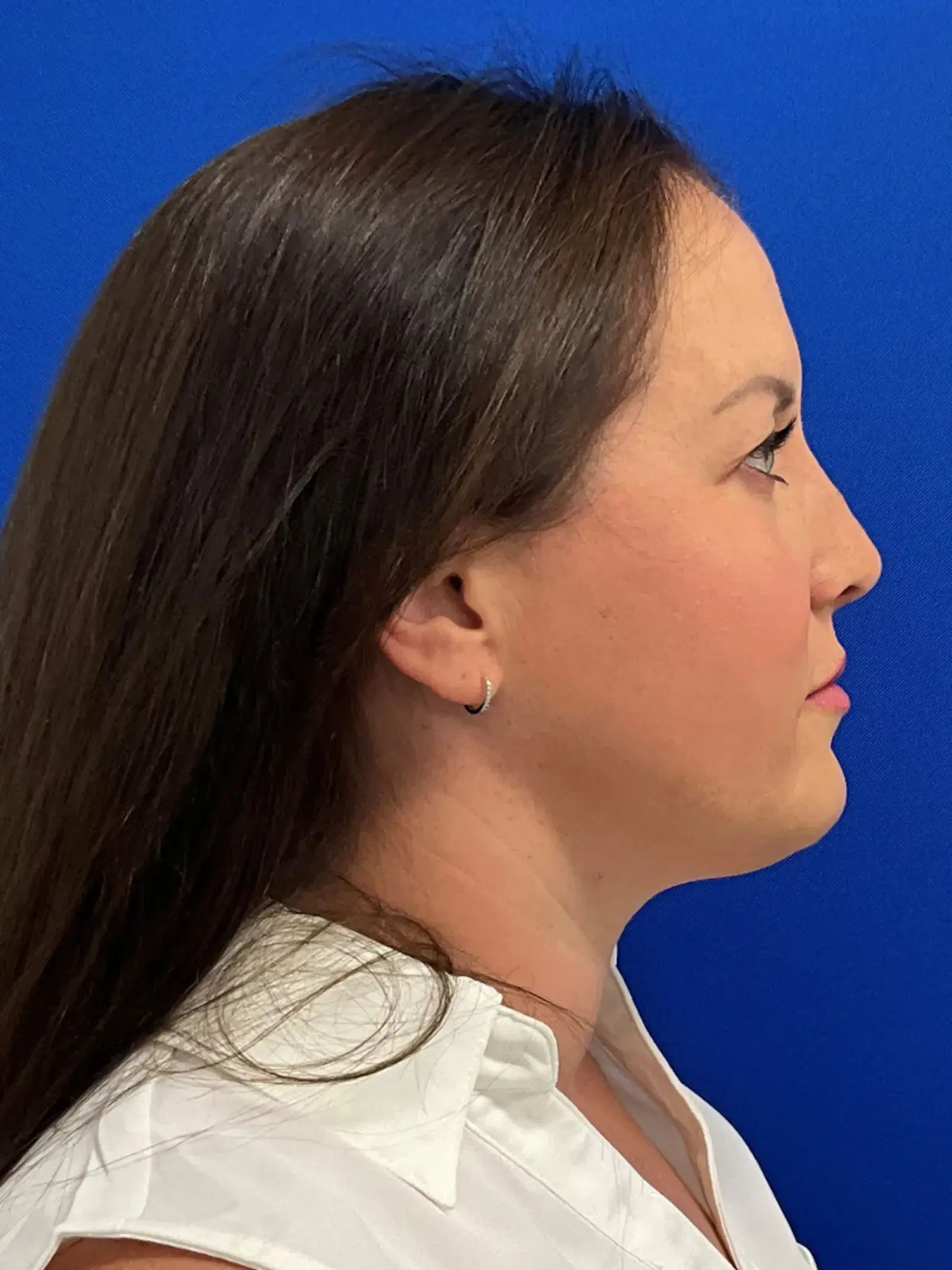 Palm Beach Plastic Surgery Institute rhinoplasty after — West Palm Beach, FL