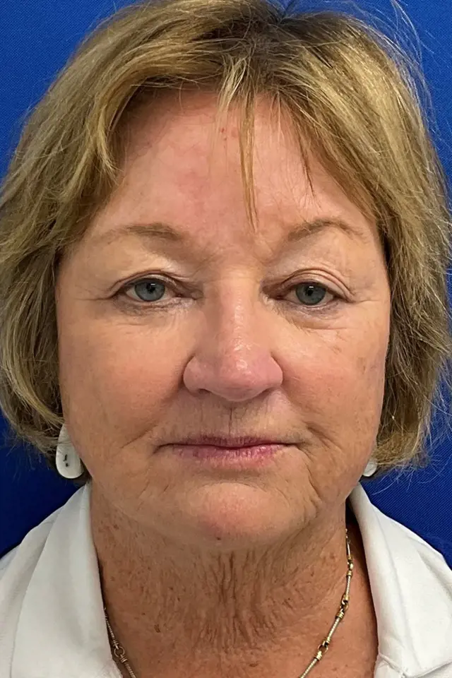 Blepharoplasty before at Palm Beach Plastic Surgery Institute in West Palm Beach, FL
