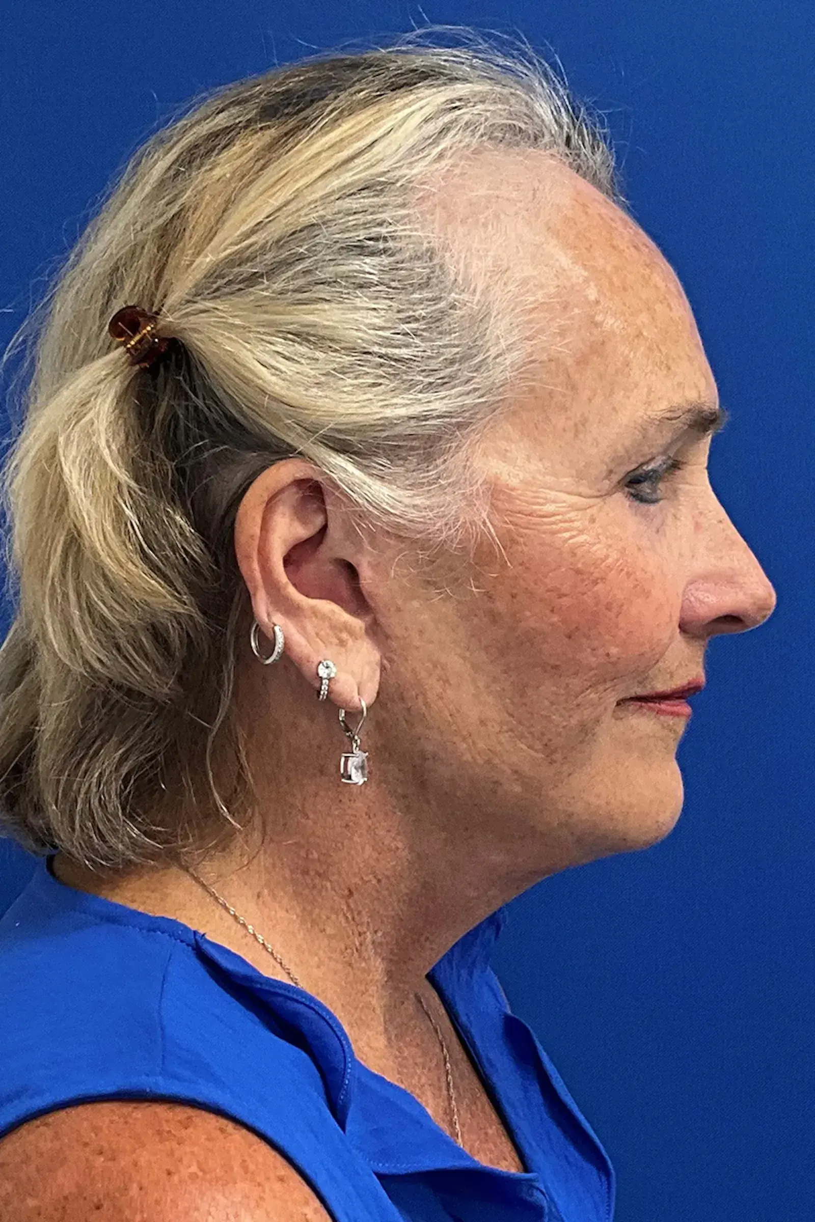Palm Beach Plastic Surgery Institute facelift after — West Palm Beach, FL