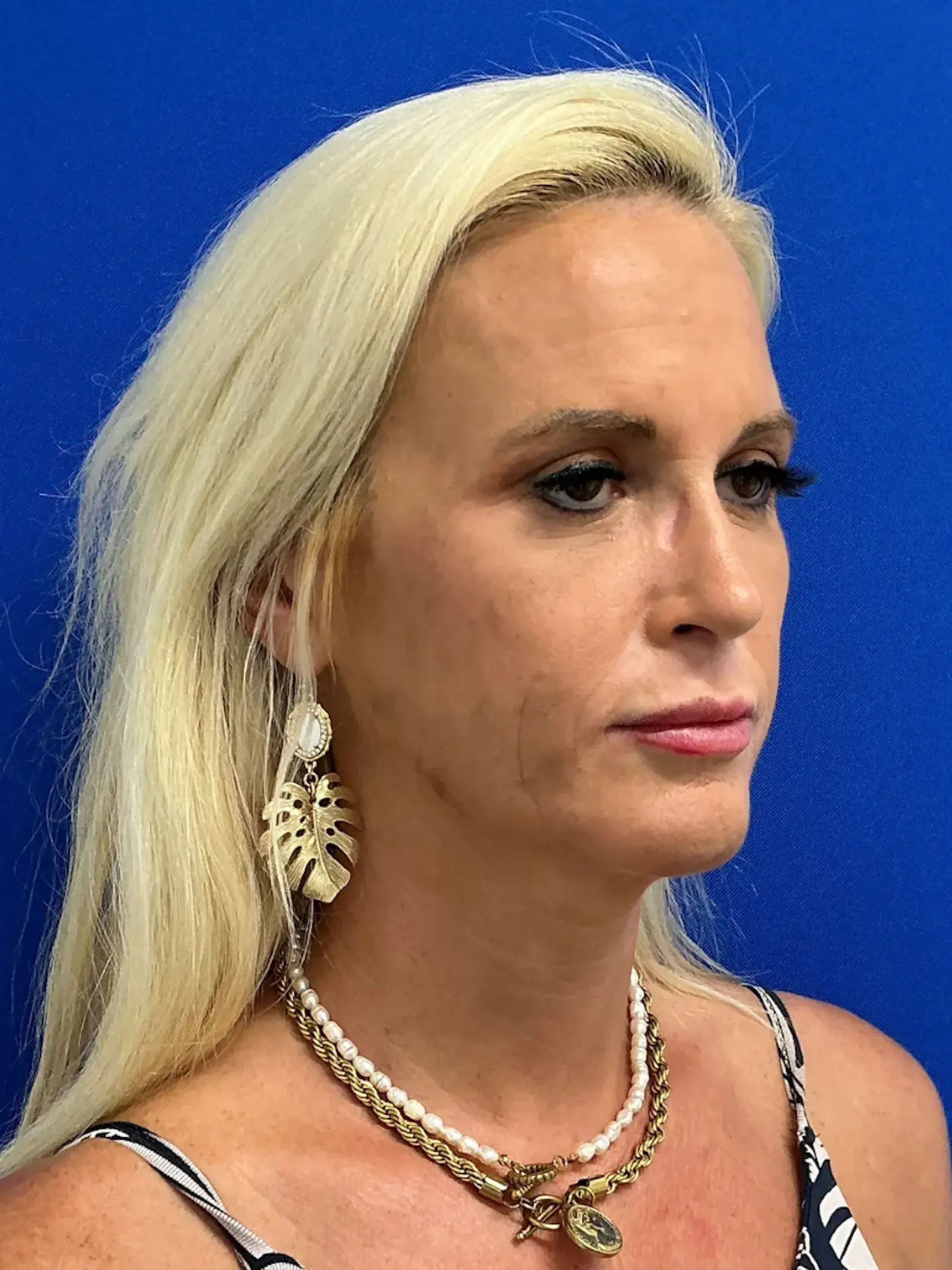 Palm Beach Plastic Surgery Institute rhinoplasty after — West Palm Beach, FL