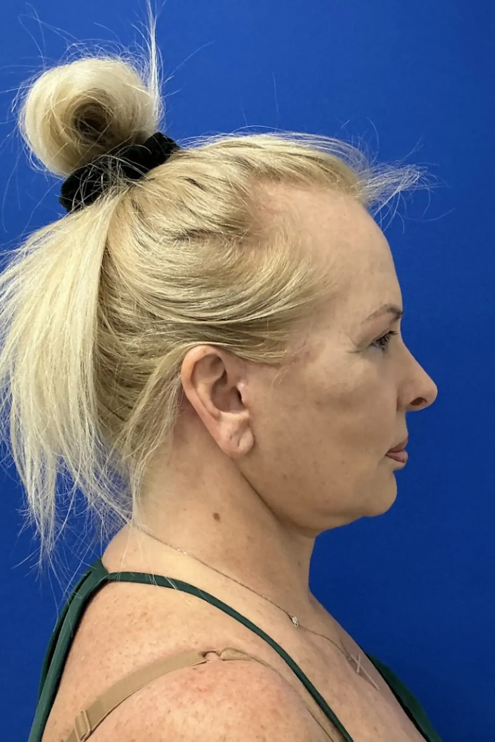 Palm Beach Plastic Surgery Institute facelift after — West Palm Beach, FL
