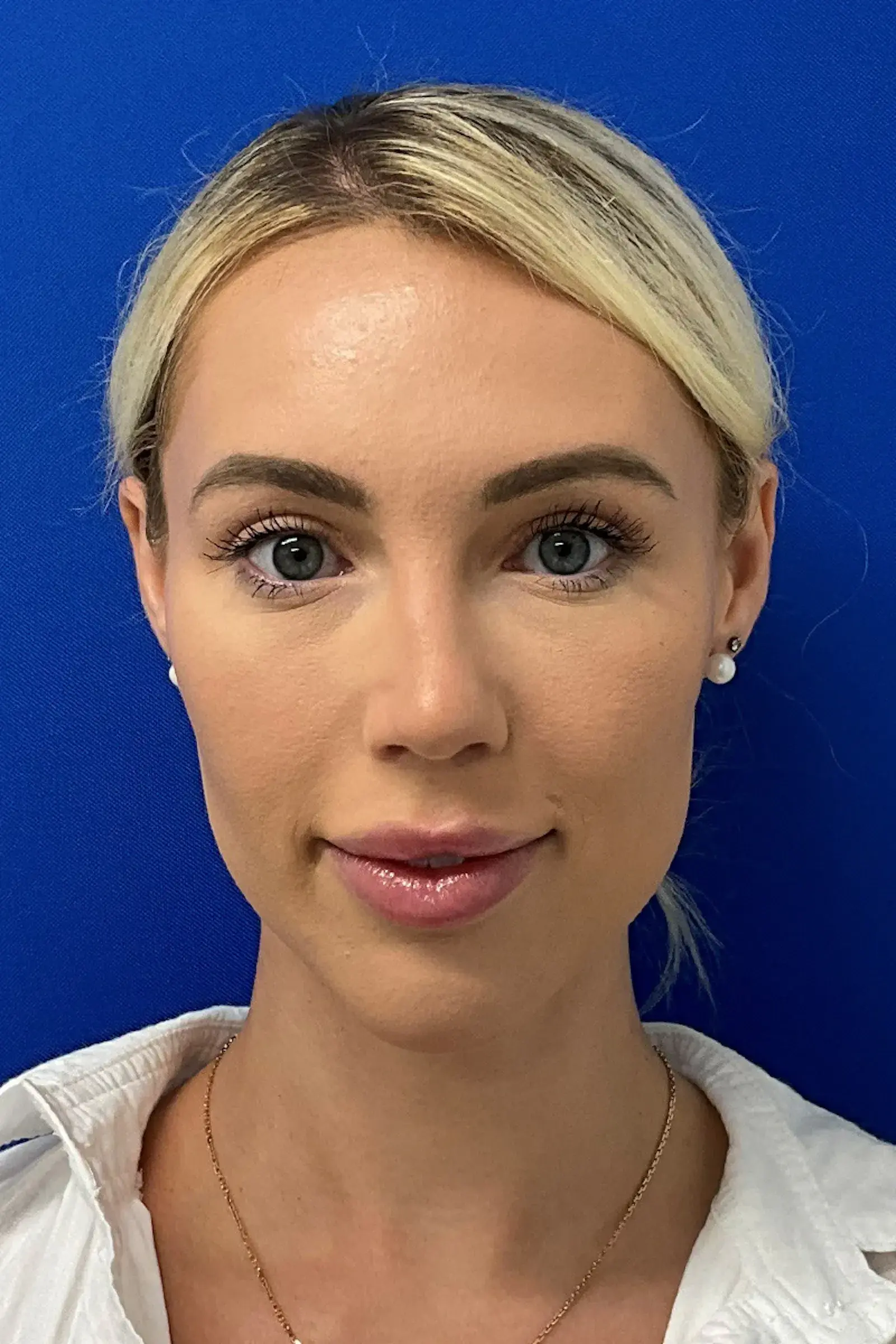 Palm Beach Plastic Surgery Institute blepharoplasty after — West Palm Beach, FL