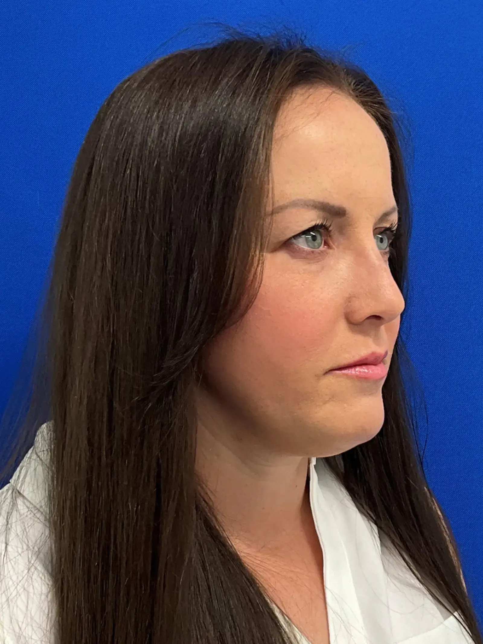 Palm Beach Plastic Surgery Institute rhinoplasty after — West Palm Beach, FL