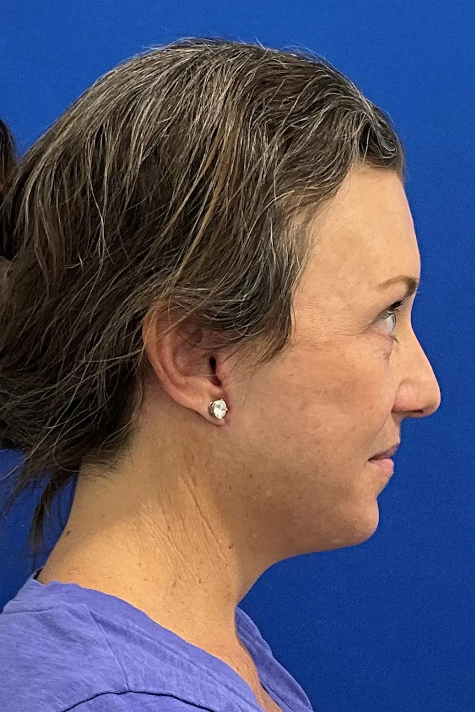 Palm Beach Plastic Surgery Institute facelift after — West Palm Beach, FL