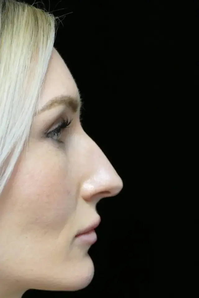 Functional Rhinoplasty before at Dr. Kanodia Rhinoplasty in Beverly Hills, CA