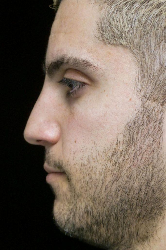Dr. Kanodia Rhinoplasty rhinoplasty after — Beverly Hills, CA