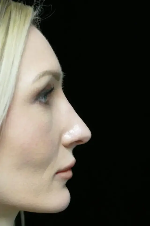 Functional Rhinoplasty after at Dr. Kanodia Rhinoplasty in Beverly Hills, CA