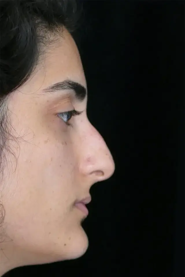 Functional Rhinoplasty before at Dr. Kanodia Rhinoplasty in Beverly Hills, CA