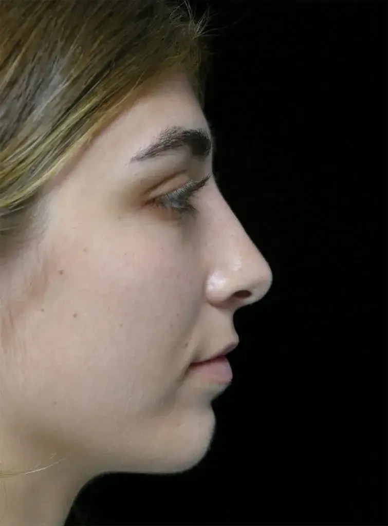 Dr. Kanodia Rhinoplasty rhinoplasty after — Beverly Hills, CA