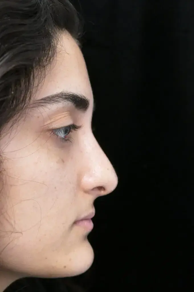 Dr. Kanodia Rhinoplasty rhinoplasty after — Beverly Hills, CA