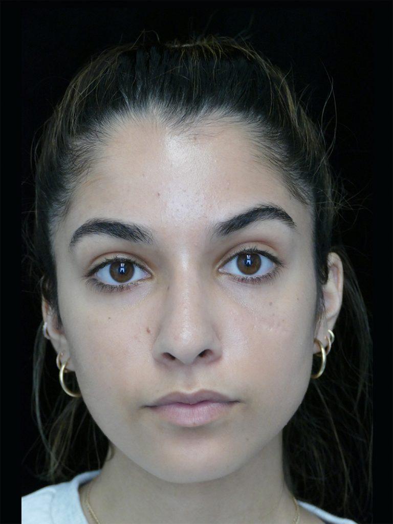 Dr. Kanodia Rhinoplasty rhinoplasty after — Beverly Hills, CA