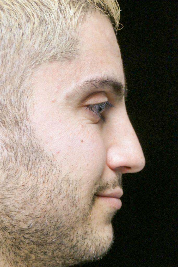Dr. Kanodia Rhinoplasty rhinoplasty after — Beverly Hills, CA
