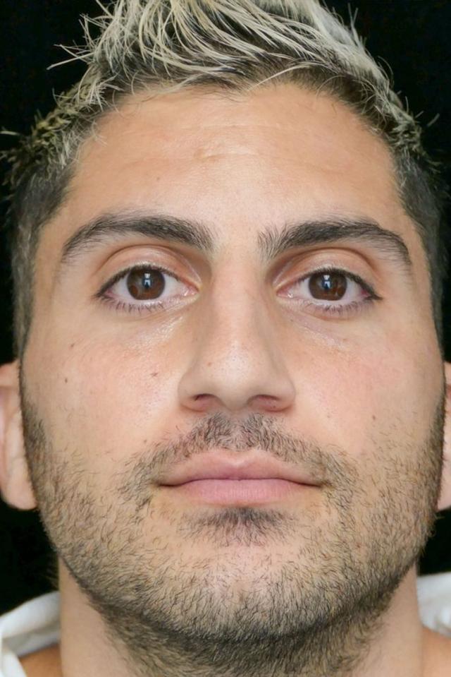 Rhinoplasty before at Dr. Kanodia Rhinoplasty in Beverly Hills, CA