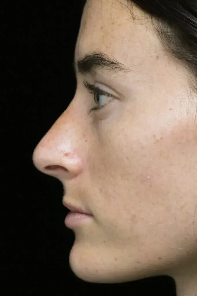 Dr. Kanodia Rhinoplasty rhinoplasty after — Beverly Hills, CA