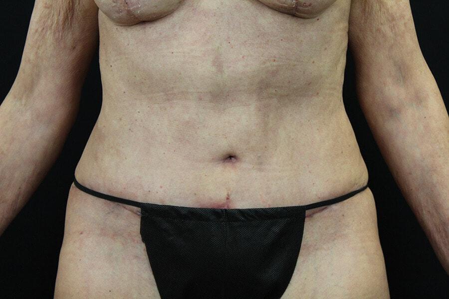 Daniel Urias, MD tummy tuck after — Orange, CA