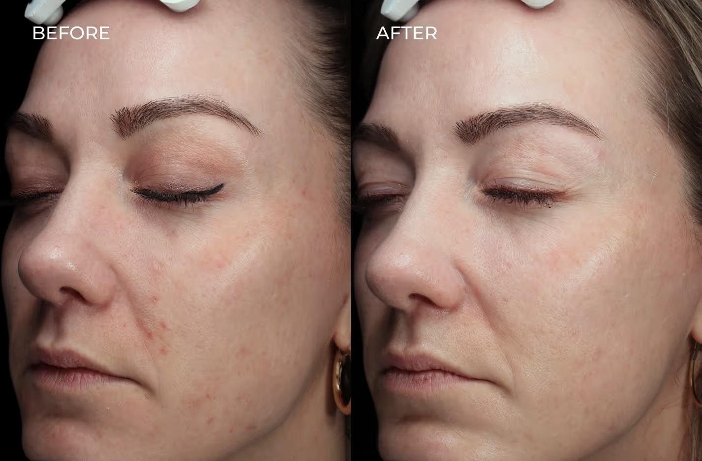 SOM Aesthetics | Dermatologist-Led Med Spa - Botox, Fillers & Laser in Encinitas laser treatment result — Encinitas, CA