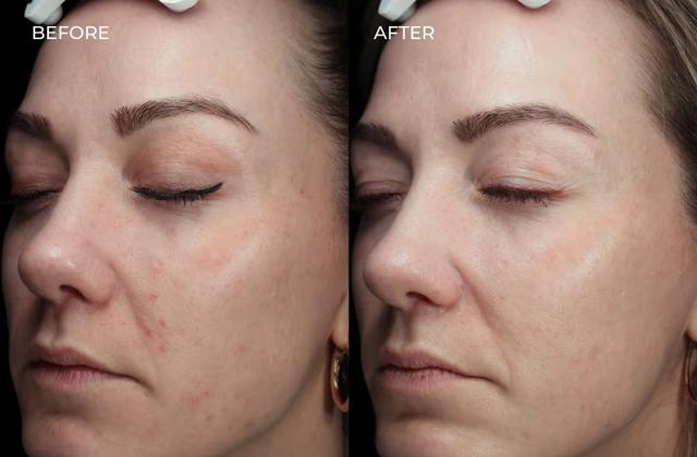 Laser Skin Resurfacing result at SOM Aesthetics | Dermatologist-Led Med Spa - Botox, Fillers & Laser in Encinitas in Encinitas, CA