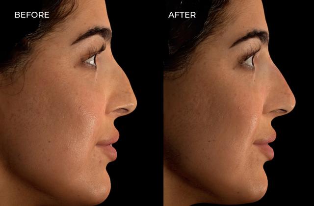 Rhinoplasty result at SOM Aesthetics | Dermatologist-Led Med Spa - Botox, Fillers & Laser in Encinitas in Encinitas, CA