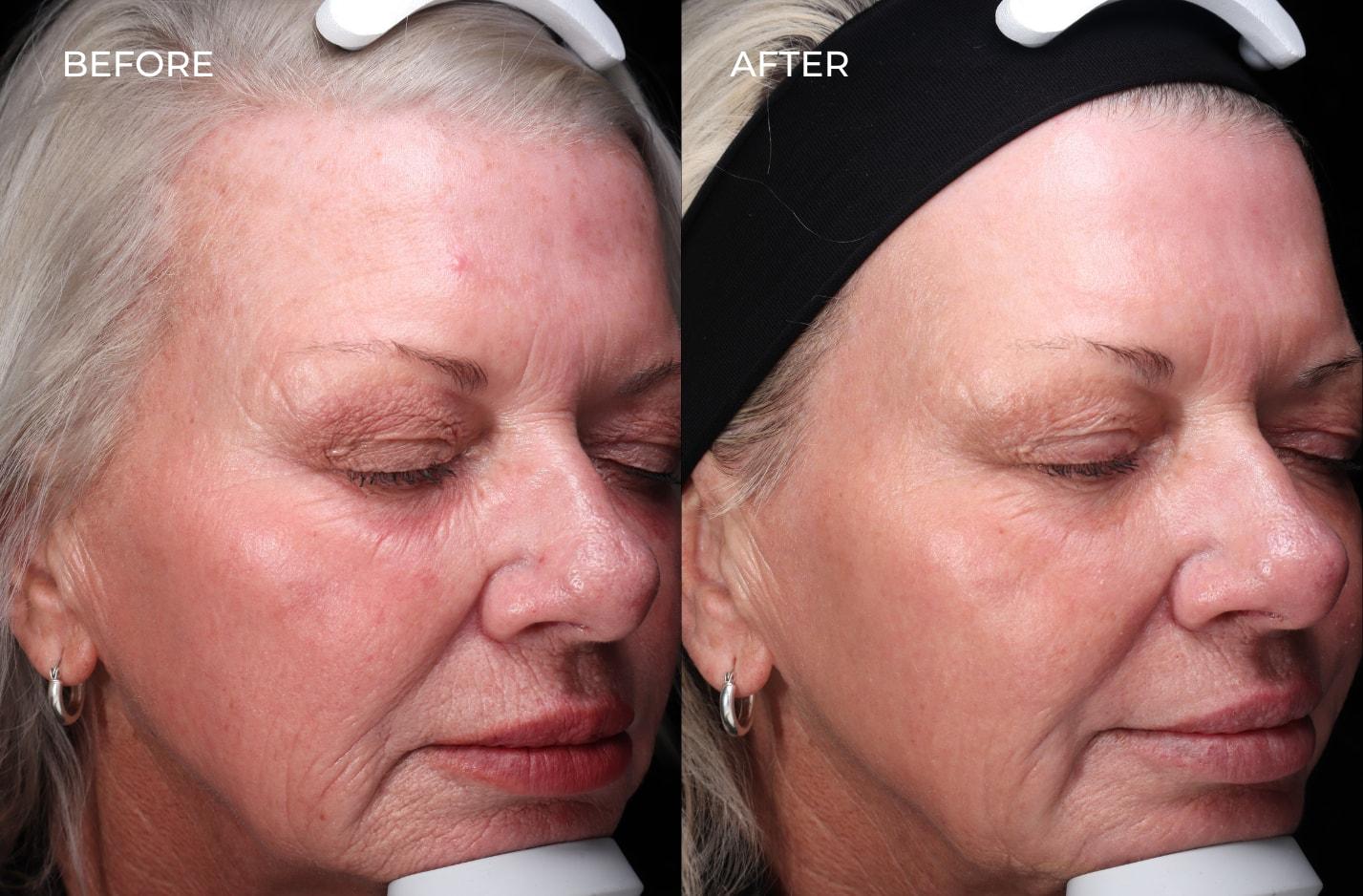 SOM Aesthetics | Dermatologist-Led Med Spa - Botox, Fillers & Laser in Encinitas photofacial result — Encinitas, CA
