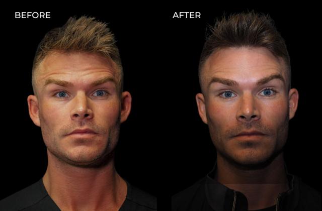 Botox result at SOM Aesthetics | Dermatologist-Led Med Spa - Botox, Fillers & Laser in Encinitas in Encinitas, CA