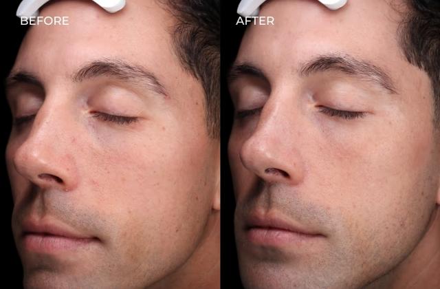 Laser Skin Resurfacing result at SOM Aesthetics | Dermatologist-Led Med Spa - Botox, Fillers & Laser in Encinitas in Encinitas, CA