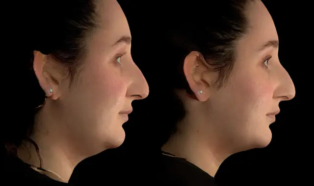 Neck Liposuction result at SOM Aesthetics | Dermatologist-Led Med Spa - Botox, Fillers & Laser in Encinitas in Encinitas, CA
