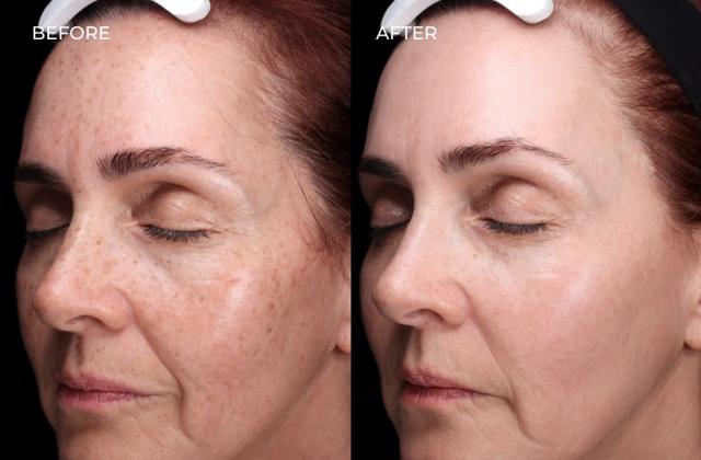 Laser Skin Resurfacing result at SOM Aesthetics | Dermatologist-Led Med Spa - Botox, Fillers & Laser in Encinitas in Encinitas, CA