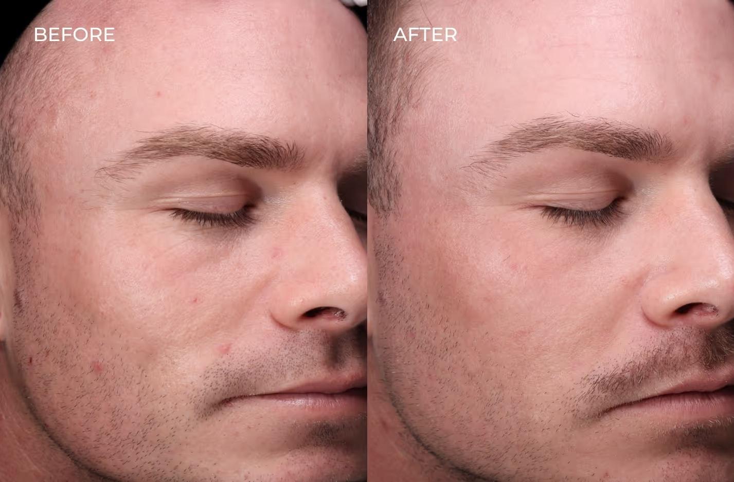 SOM Aesthetics | Dermatologist-Led Med Spa - Botox, Fillers & Laser in Encinitas laser treatment result — Encinitas, CA