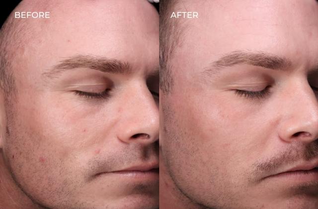 Laser Skin Resurfacing result at SOM Aesthetics | Dermatologist-Led Med Spa - Botox, Fillers & Laser in Encinitas in Encinitas, CA