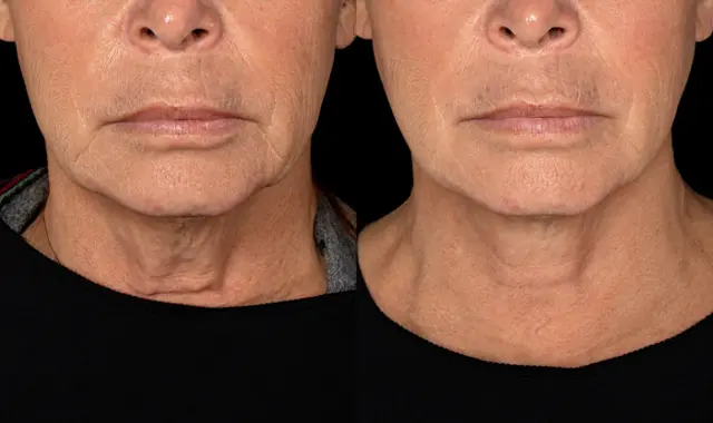 Neck Lift result at SOM Aesthetics | Dermatologist-Led Med Spa - Botox, Fillers & Laser in Encinitas in Encinitas, CA