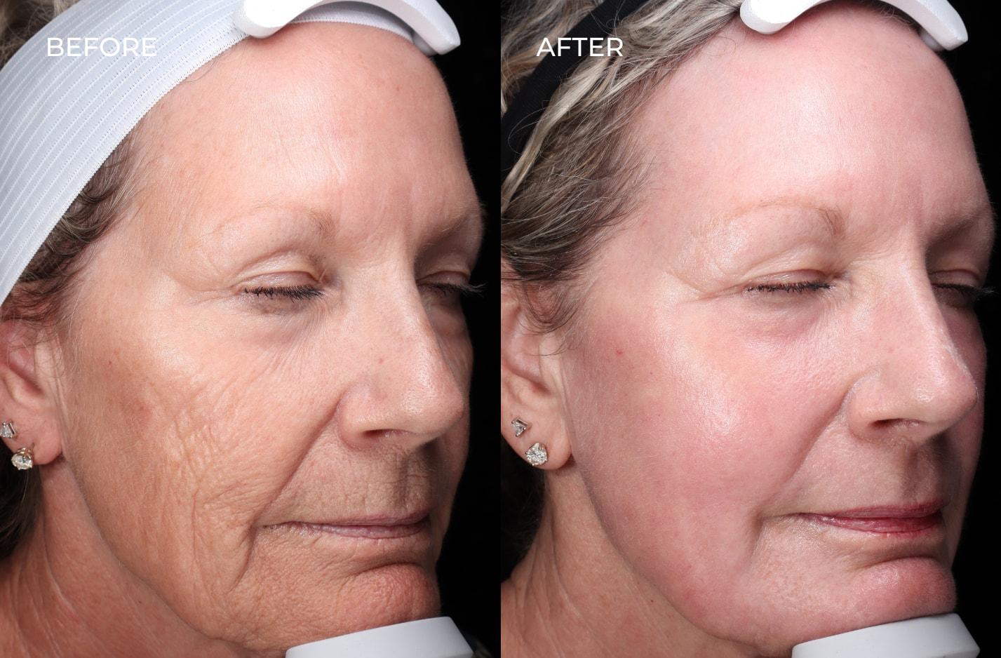 SOM Aesthetics | Dermatologist-Led Med Spa - Botox, Fillers & Laser in Encinitas photofacial result — Encinitas, CA